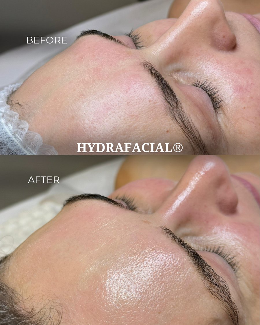 HydraFacial rezultāts — pirms un pēc procedūras