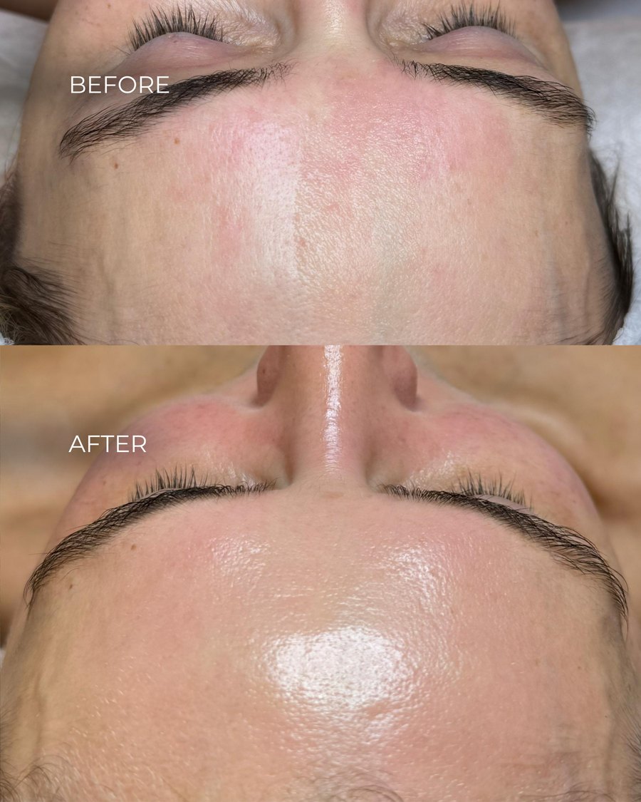 HydraFacial rezultāts pierē — pirms un pēc procedūras