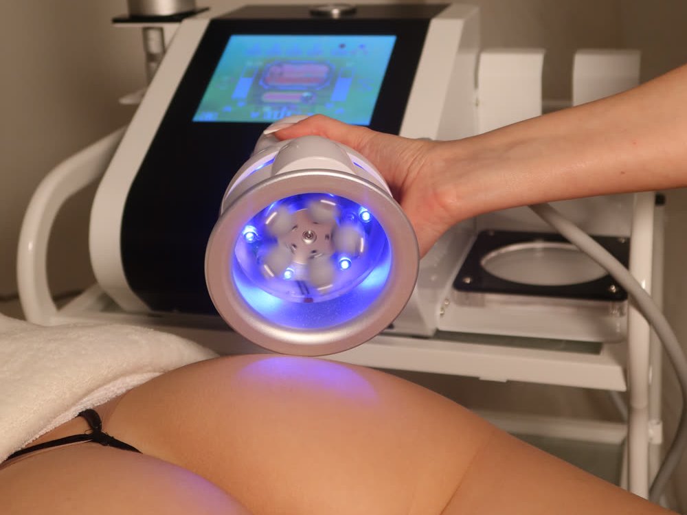 KAVITĀCIJA 20 MIN + VelaSHAPE III 45 MIN