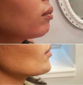 chin-fat-reduction-with-lipolysis-290x300