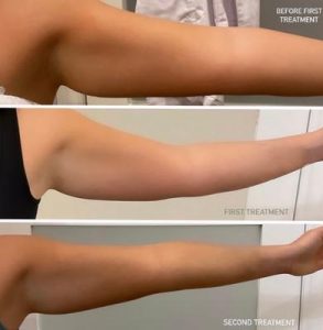 lipolysis-arm-treatment-293x300