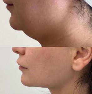 lipolysis-chin-fat-reduction-293x300