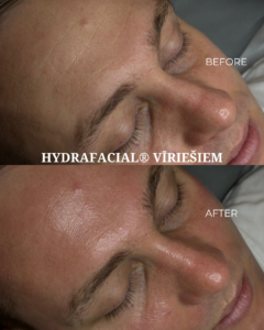 HydraFacial® vīriešiem - 1