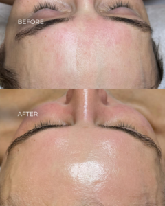 HydraFacial® vīriešiem - 17