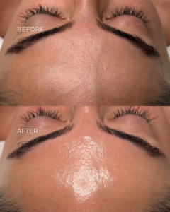 HydraFacial® vīriešiem - 7